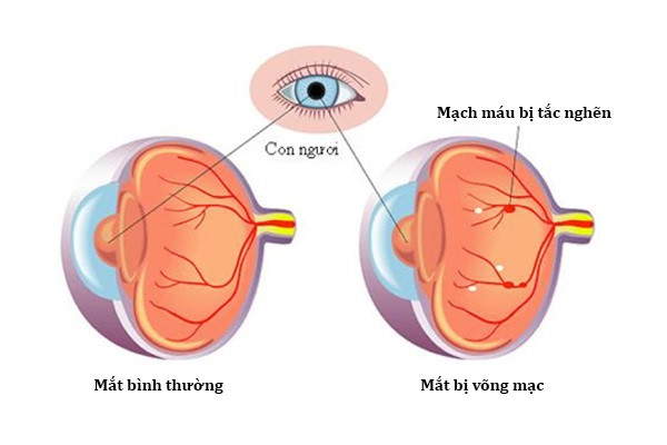 Biến chứng về mắt